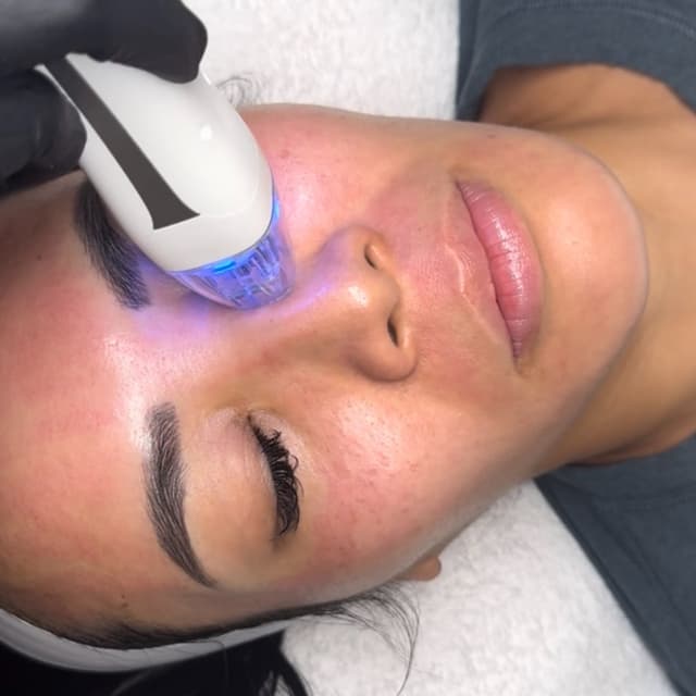 3: VirtueRF+AquaFacial at Skyn 32 Aesthetics Studio in Dallas, TX